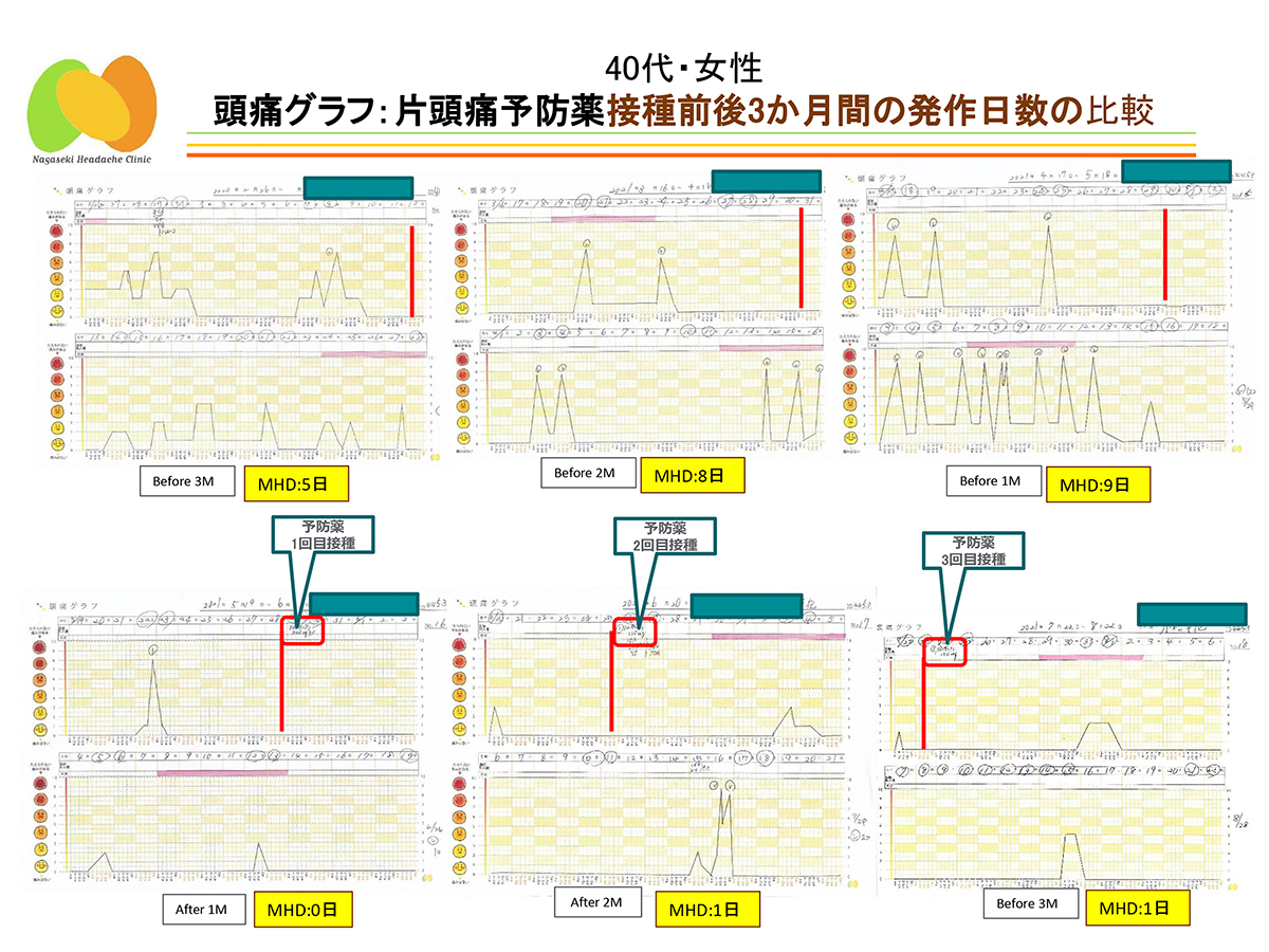片頭痛予防薬接種前後3か月の発作日数の比較