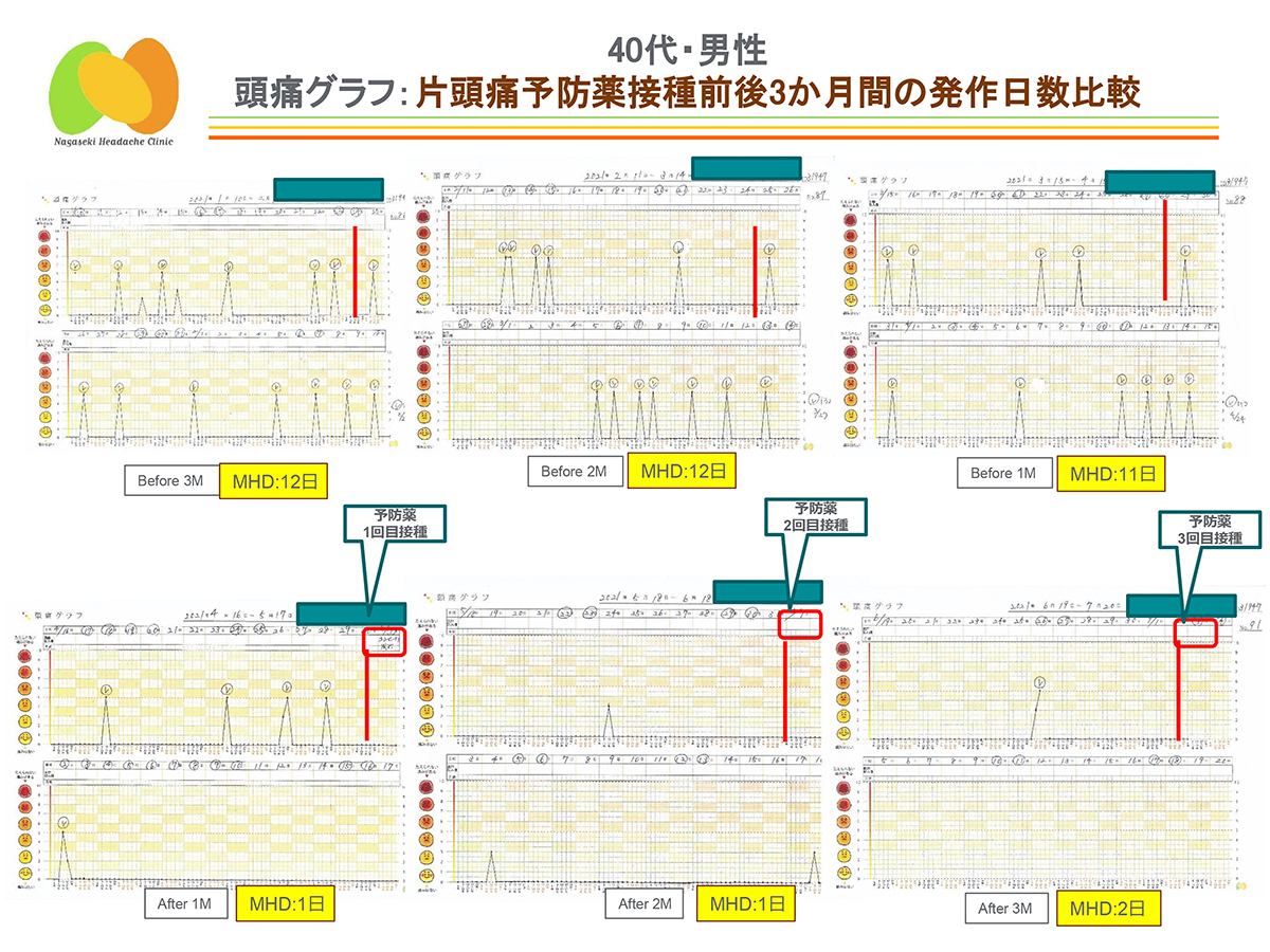 片頭痛予防薬接種前後3か月の発作日数の比較
